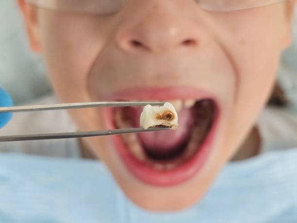 Best Emergency Dental Care for Broken or Chipped Teeth in Riverdale, CA